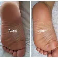60MN CALLUS PEELING ( Spécial Callosités ) 