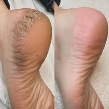 90MN PACK CALLUS PEELING ( Spécial Callosité + Ayurvédique ) 